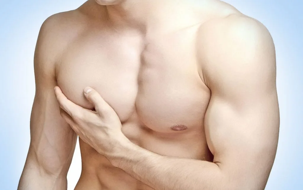 Gynecomastia