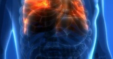 lung cancer