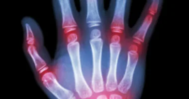Gout